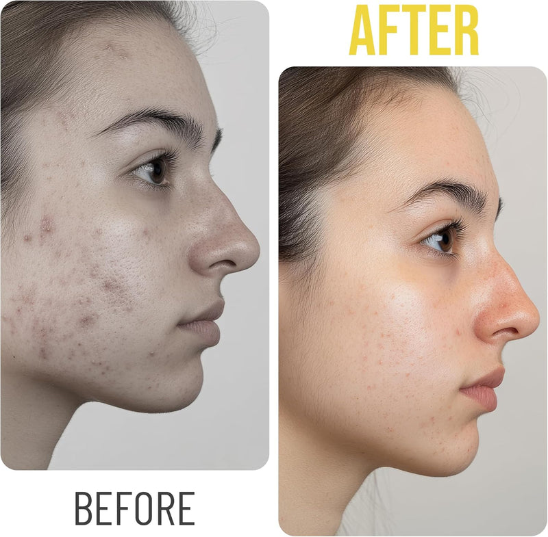 Chic Derma Pimple Patches – 36 Count Heart Shaped Hydrocolloid Stickers – Gentle Patches for Face and Skin Care – Heart Shapes Spot Cover for Day and Night Use