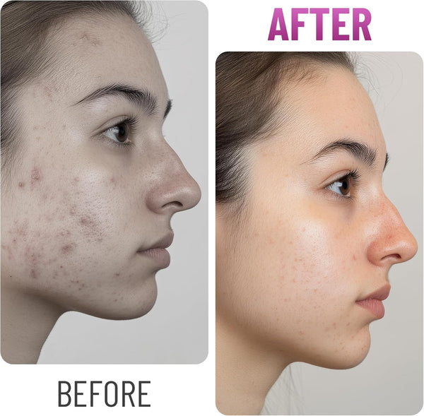 Chic Derma Pimple Patches – 72 Count Star and Heart Hydrocolloid Stickers – Gentle Patches for Face and Skin Care – Cute Star and Heart Shapes Spot Cover for Day and Night Use